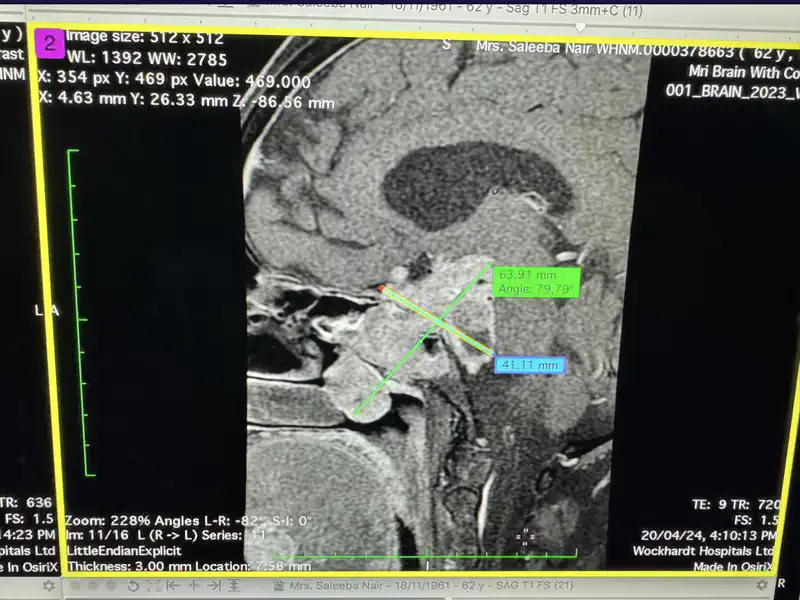 Rare and Largest Tumor Removed from A 63-Year-Old Woman’s Pituitary Gland